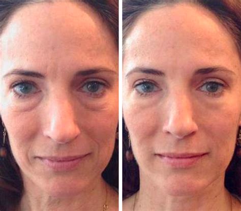 jade roller benefits before and after